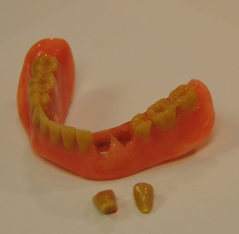 Denture Missing Teeth